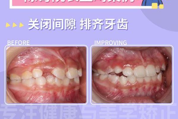 八字牙齿