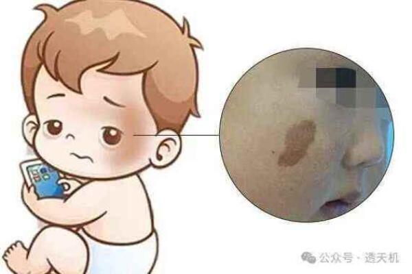 怎么看胎记算命-