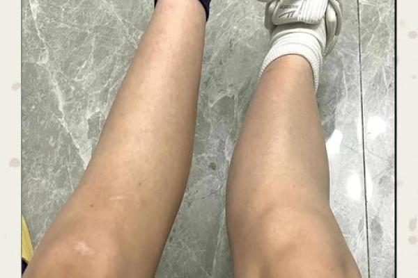 八字脚多的原因及如何缓解