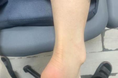 八字型腿