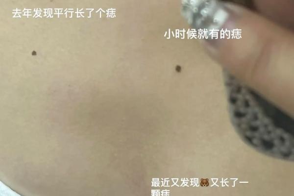 胸部痣相图解算命