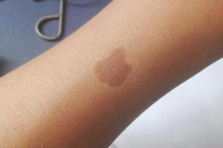 身体上的胎记位置不同算命分析