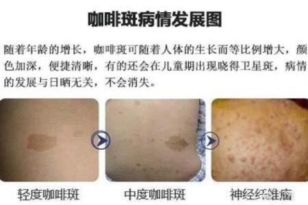 面部上的胎记算命分析