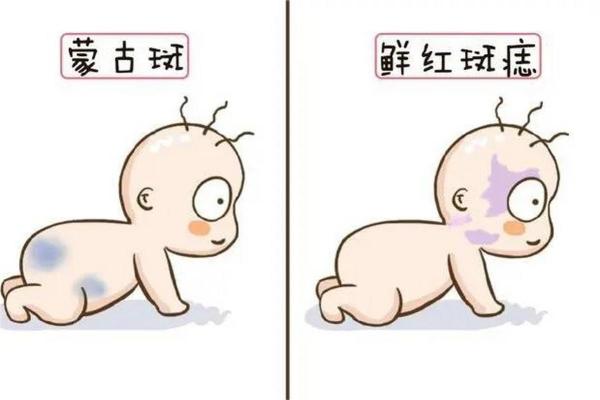 看胎记颜色类型算命