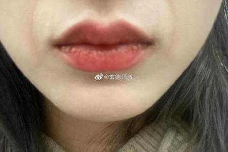 嘴巴八字纹