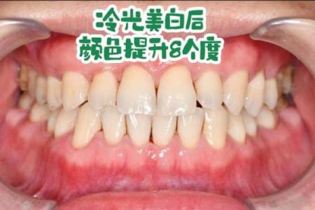 牙齿算命：牙齿的颜色看你的运势