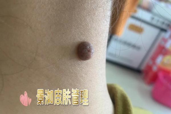 风水上女生脖子后面有痣代表什么啊